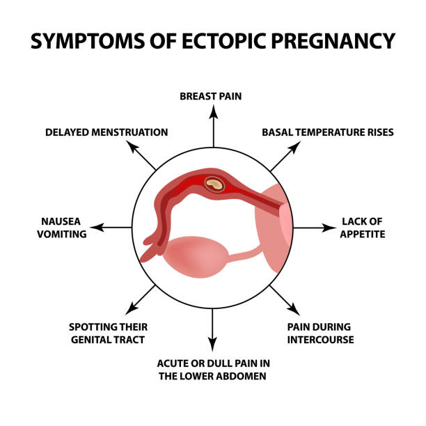 50+ Ectopic Pregnancy Illustrations Stock Illustrations, Royalty-Free  Vector Graphics & Clip Art - iStock