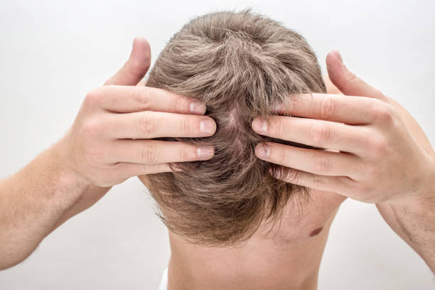istock Young man hold hands on hair and show bald spot. He has problem. Isolated on white background. 1080199900