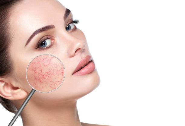magnifying glass showing couperose on womans face magnifying glass showing couperose on face skin. Woman showing problems couperose-prone sensitive skin cheek photos stock pictures, royalty-free photos & images