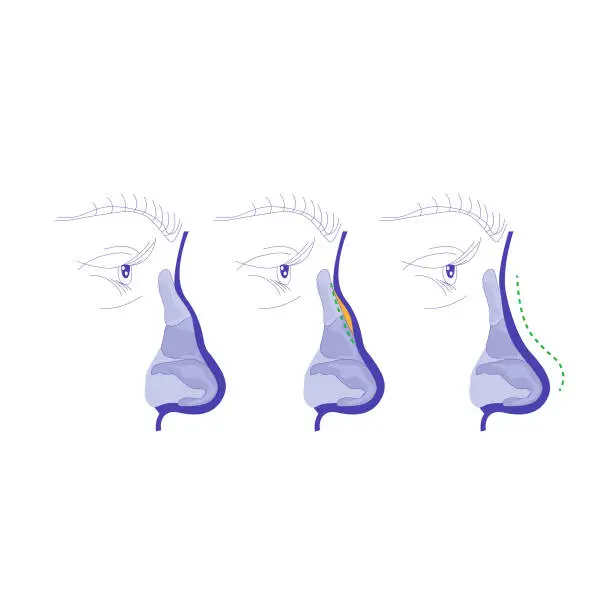 Vector illustration of nose esthetic procedure infographic.