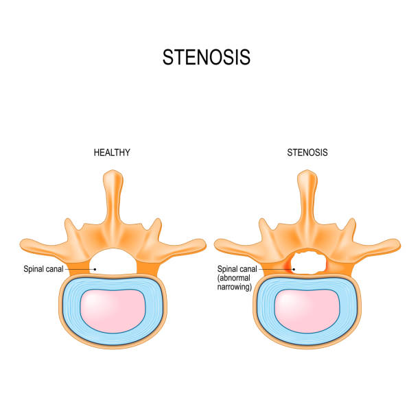 ilustrações, clipart, desenhos animados e ícones de estenose espinhal lombar é um estreitamento anormal no canal espinhal. - human spine human vertebra disk spinal