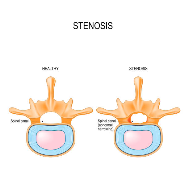 Lumbar Spinal Stenosis is an abnormal narrowing in spinal canal. Lumbar Spinal Stenosis is an abnormal narrowing in spinal canal. section of the human vertebral column and cross-section of spinal cord. Vector illustration for medical, biological, and educational use narrow stock illustrations