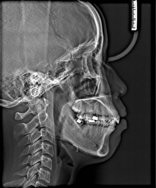 istock X-ray film Head and mouth 1080537600