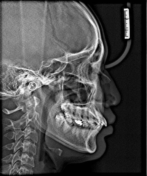istock X-ray film Head and mouth 1080541158