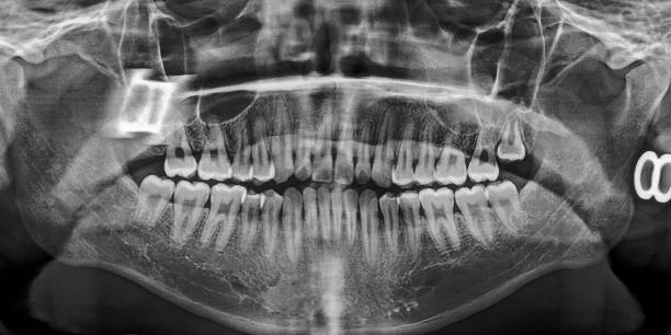 istock X-ray film Head and mouth 1080542486