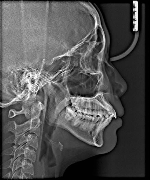 istock X-ray film Head and mouth 1080548130