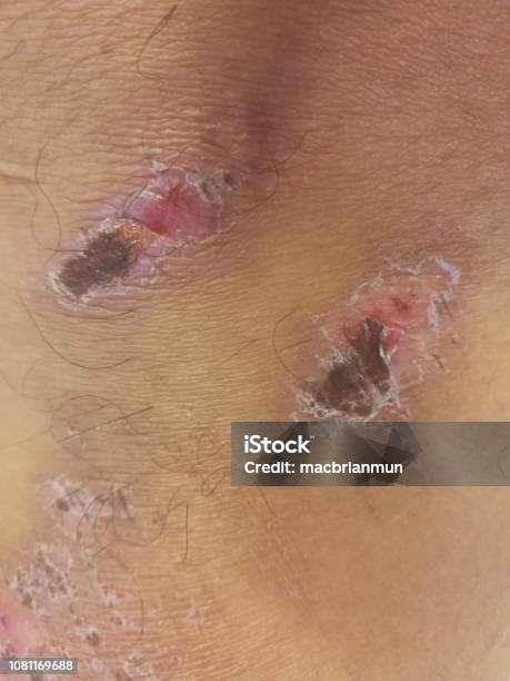 Dried Wound On The Leg Stock Photo - Download Image Now - Blood, Care, Close-up