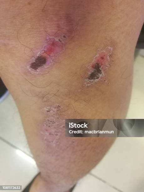 Dried Wound On The Leg Stock Photo - Download Image Now - Blood, Care, Close-up