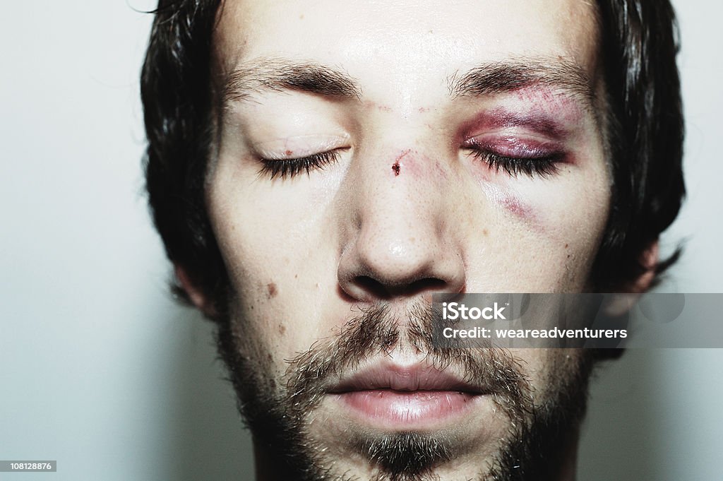 Victim of Assault  Human Face Stock Photo