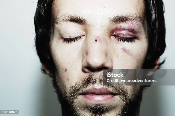 Victim Of Assault Stock Photo - Download Image Now - Human Face, Beaten Up, Bruise