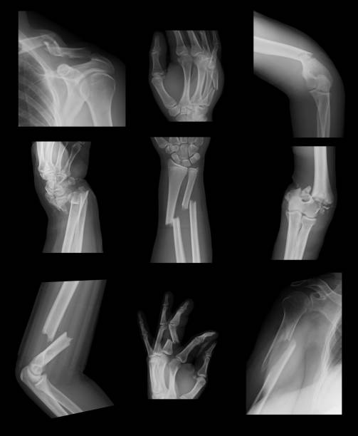 collection x-ray image of upper extremity fractures - x ray x ray image shoulder human arm imagens e fotografias de stock