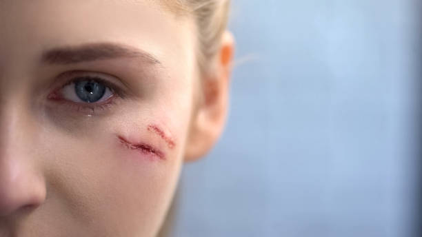 istock Young woman with deep scars on face crying and looking at camera, close up 1081346164
