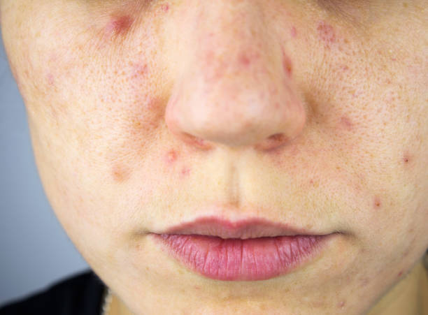 młoda kobieta z trądzikiem, melasma, ciemne plamy, piegi na twarzy. dermatologia, problem pielęgnacji skóry i obraz koncepcji zdrowia. część ciała, selektywne skupienie. - pus zdjęcia i obrazy z banku zdjęć