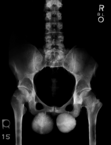 The hip bone is comprised of the three parts the ilium, pubis and ischium 3d illustration