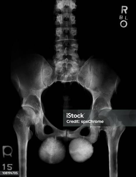 Kulki Ze Stali - zdjęcia stockowe i więcej obrazów Jądro - Jądro, Wielki, Diagnostyka obrazowa