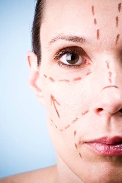 istock Woman's Face with Cosmetic Facelift Markings 108196134