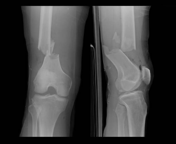 무릎의 x 선 이미지 - cartilage patella human knee medical exam 뉴스 사진 이미지