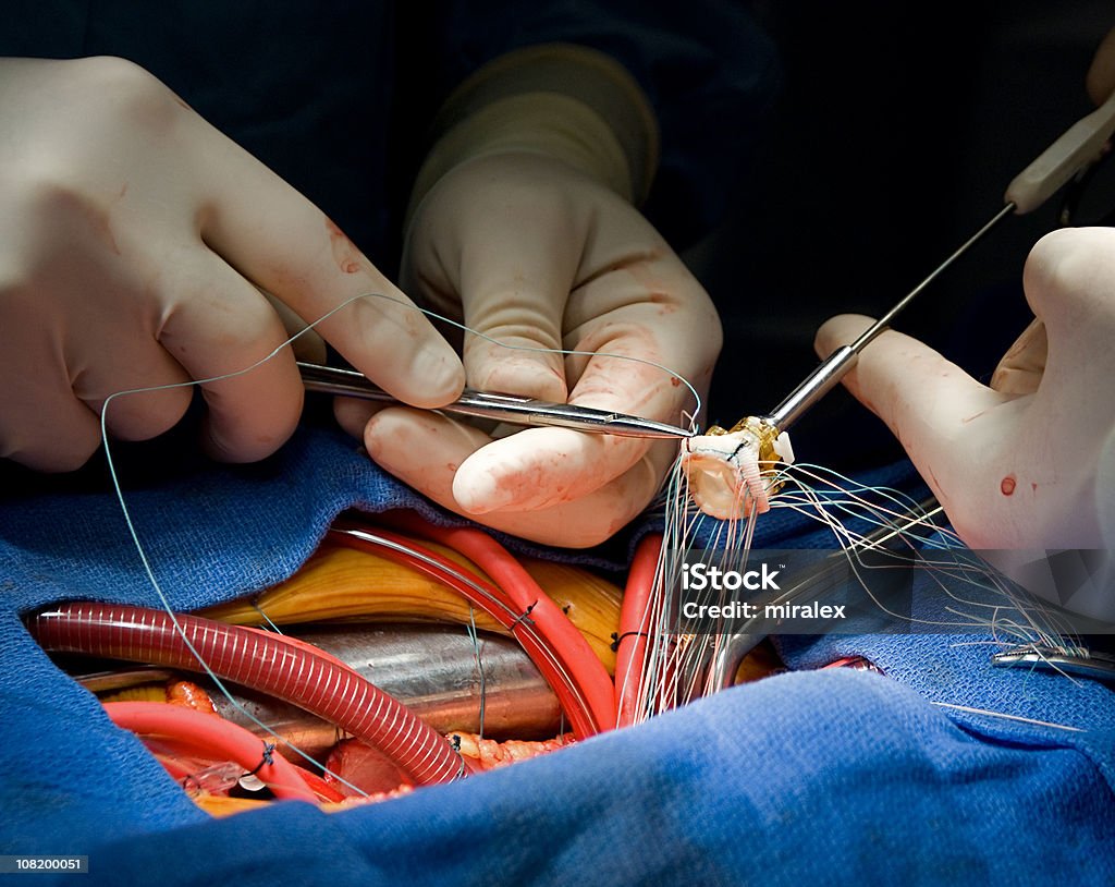 Chirurgia serca Zastawka aortalna zastępczego - Zbiór zdjęć royalty-free (Aorta)