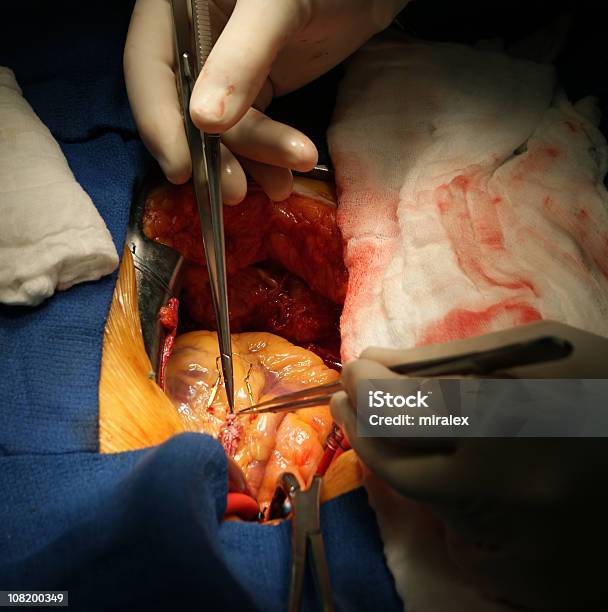 Cirurgia De Bypass Cardíaco - Fotografias de stock e mais imagens de Cirurgia Cardíaca - Cirurgia Cardíaca, Artéria Coronária, Artéria Humana