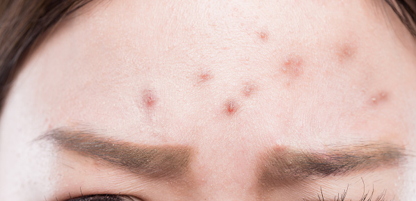 close up of facial acne on forehead