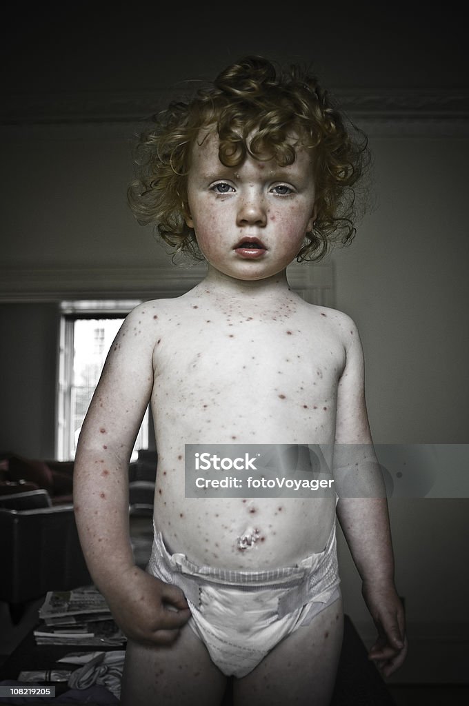 Portrait of child with Chicken Pox  Chickenpox Stock Photo
