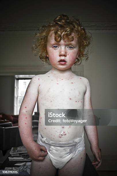 Portrait Of Child With Chicken Pox Stock Photo - Download Image Now - Chickenpox, Childhood, Diaper
