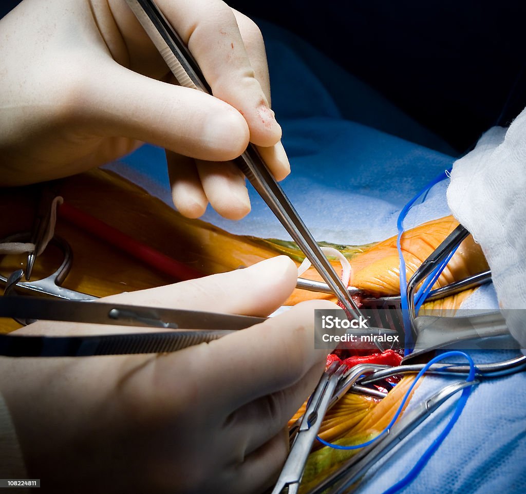 Tissu vasculaire chirurgie Endarterectomy carotide - Photo de Artère carotide libre de droits