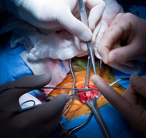 endarterectomía carotídea cirugía vascular - surgery human artery human hand carotid artery fotografías e imágenes de stock