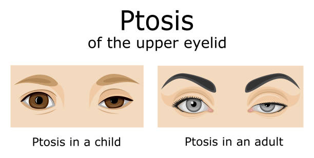 ilustracja ptosis górnej powieki - congenital stock illustrations