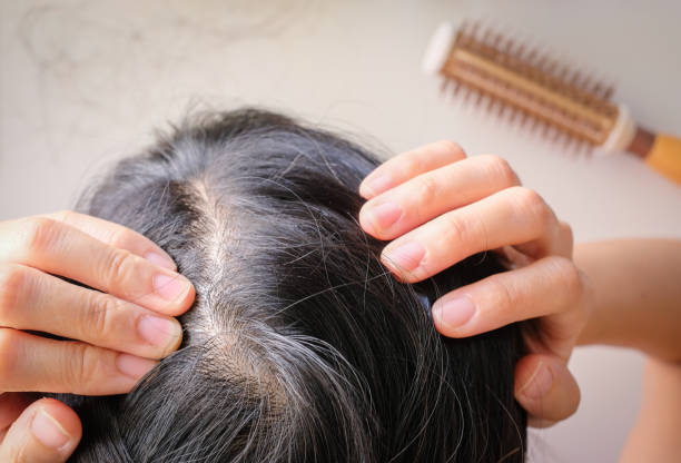 istock hair fall and lost alopecia woman problem on the comb. 1082863366