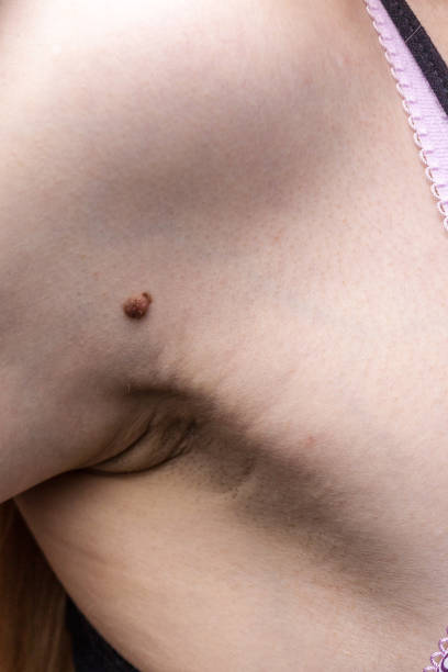 istock Dark fibroma on skin 1082892362