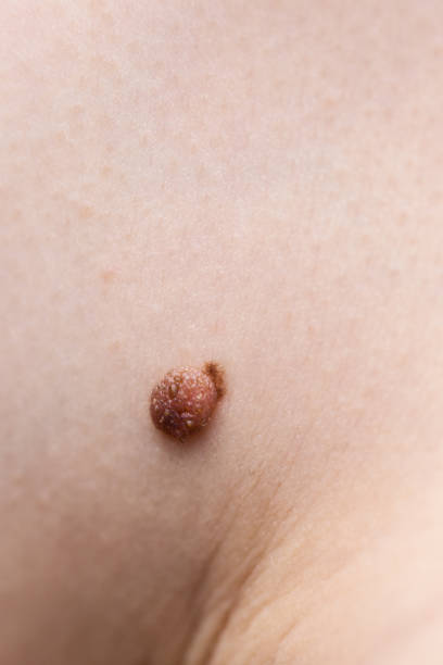istock Dark fibroma on skin 1082894764