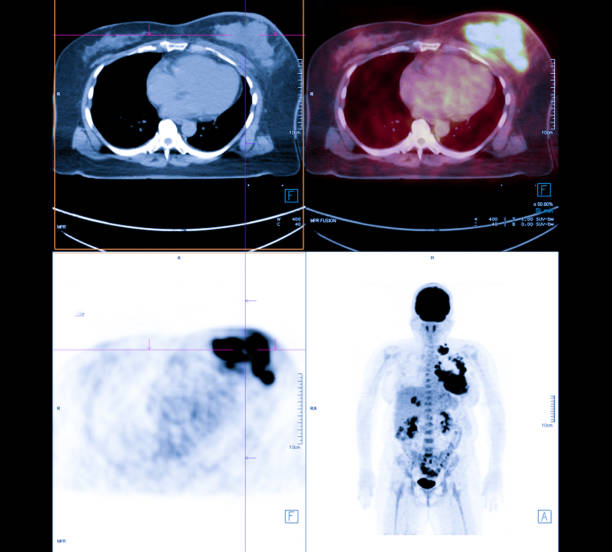 PET Scan image of whole body Comparison Axial , Coronal  plane in patient breast cancer recurrence treatment. PET Scan image of whole body Comparison Axial , Coronal  plane in patient breast cancer recurrence treatment. pet scan photos stock pictures, royalty-free photos & images