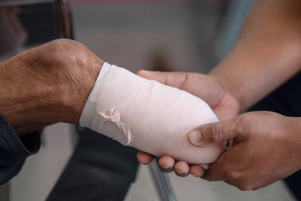 below knee amputation patient with elastic bandaging stock photo
