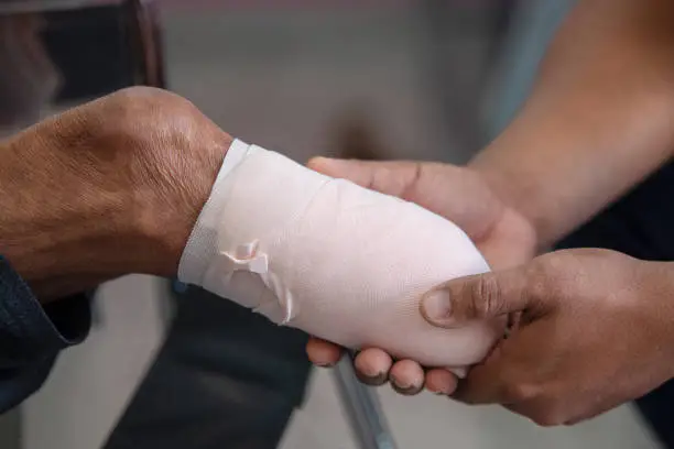 below knee amputation patient with elastic bandaging to prepare for leg prosthesis