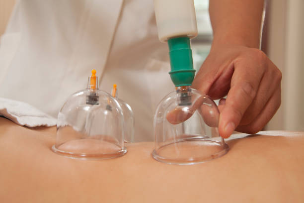 istock Chinese doctor cupping patient's back 1083107682