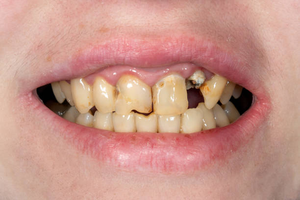 istock broken tooth closeup. Girl at the dental reception 1083274972