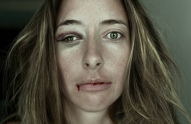 Woman with bruise and cuts on her face from physical abuse stock photo