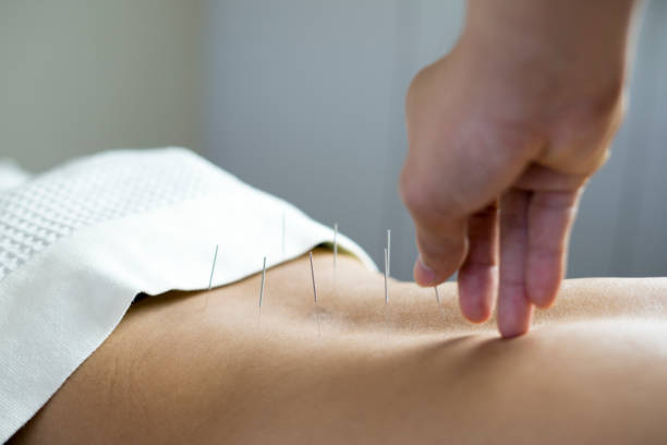 traditionelle akupunktur-behandlung - akupunkturnadel fotos stock-fotos und bilder