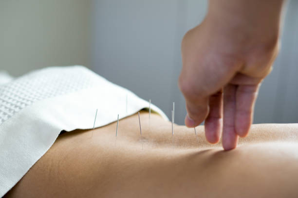 traditional acupuncture treatment - chinese traditional medicine imagens e fotografias de stock