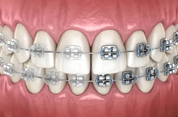 Teeth with metal and Clear braces in gums. Medically accurate dental 3D illustration