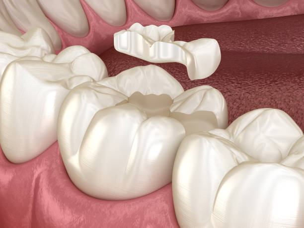 incrustation de fixation de la couronne en céramique sur la dent. médicalement exacte illustration 3d du traitement des dents humaines - inlaid photos et images de collection