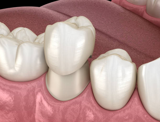 istock Dental crown premolar tooth assembly process. Medically accurate 3D illustration of human teeth treatment 1083776110
