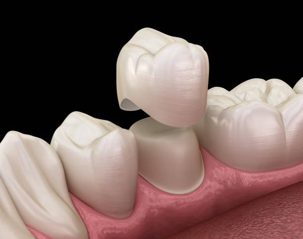 istock Dental crown premolar tooth assembly process. Medically accurate 3D illustration of human teeth treatment 1083776116