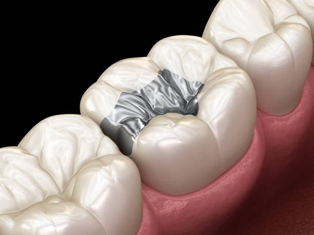 istock Inlay silver crown fixation over tooth. Medically accurate 3D illustration of human teeth treatment 1083776126