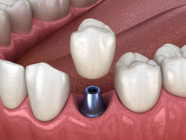 istock Premolar tooth crown installation over implant abutment. Medically accurate 3D illustration of human teeth and dentures concept 1083776136