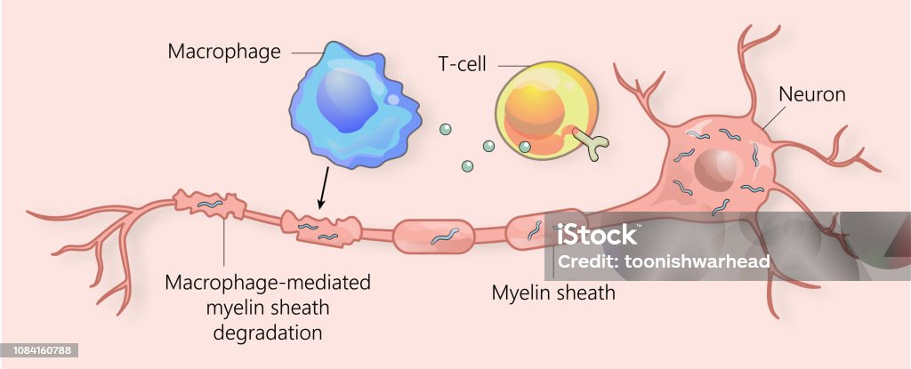 Ms Causes Multiple Sclerosis And Myelin Sheath Breakdown Stock Illustration ...