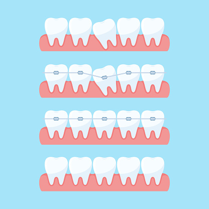 Alignment System Chart Toothpaste Stages Of Teeth Alignment Stock Illustration - Download Image Now ...