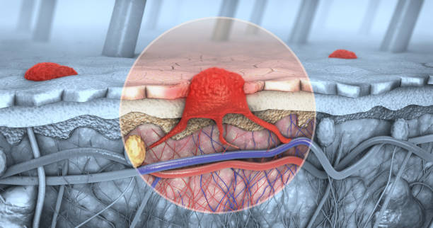 3d illustration of a cross-section of a diseased skin with melanoma that enters the bloodstream and lymphatic tract 3d illustration of a cross-section of a diseased skin with melanoma that enters the bloodstream and lymphatic tract christoph stock pictures, royalty-free photos & images