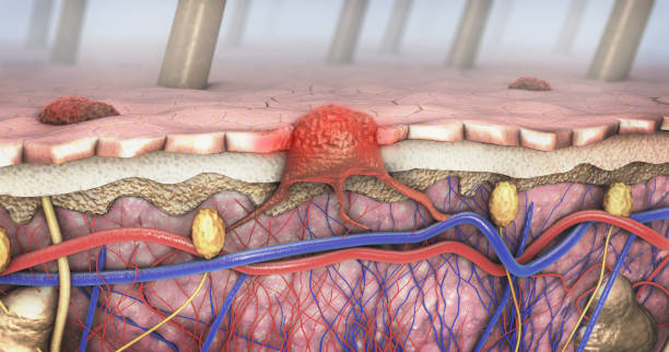 3d ilustración de un corte transversal de una piel enferma con melanoma que entra en las vías de circulación sanguínea y linfática - piel partes del cuerpo fotografías e imágenes de stock